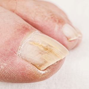 Infections des pieds par les ongles des personnes âgées : jaunissement, épaississements...